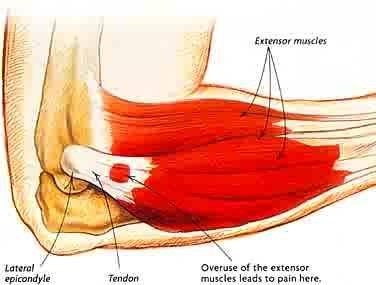 What is Tennis Elbow Injury, Causes, and Treatment?